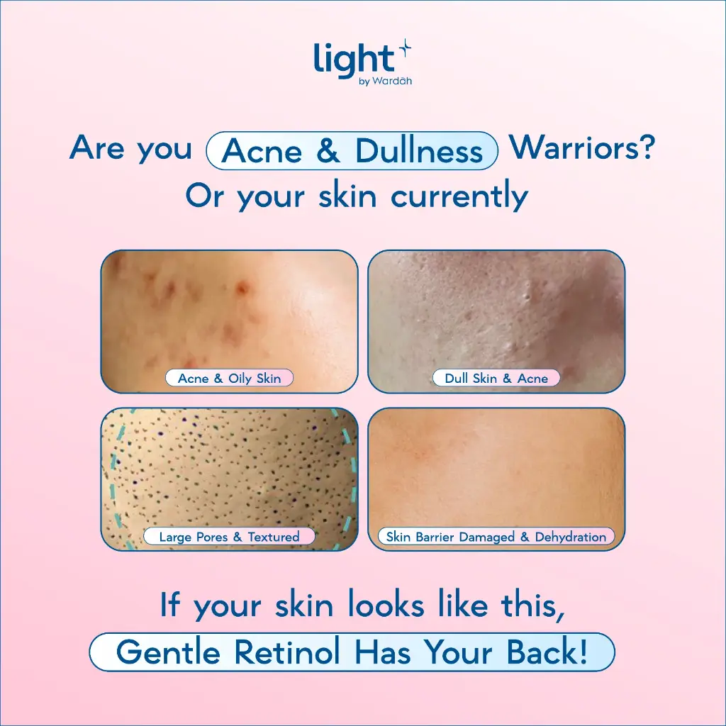 wardah-light-plus-hpr-retinoid-bright-acne-serum-moisturizer-28gr-3.webp